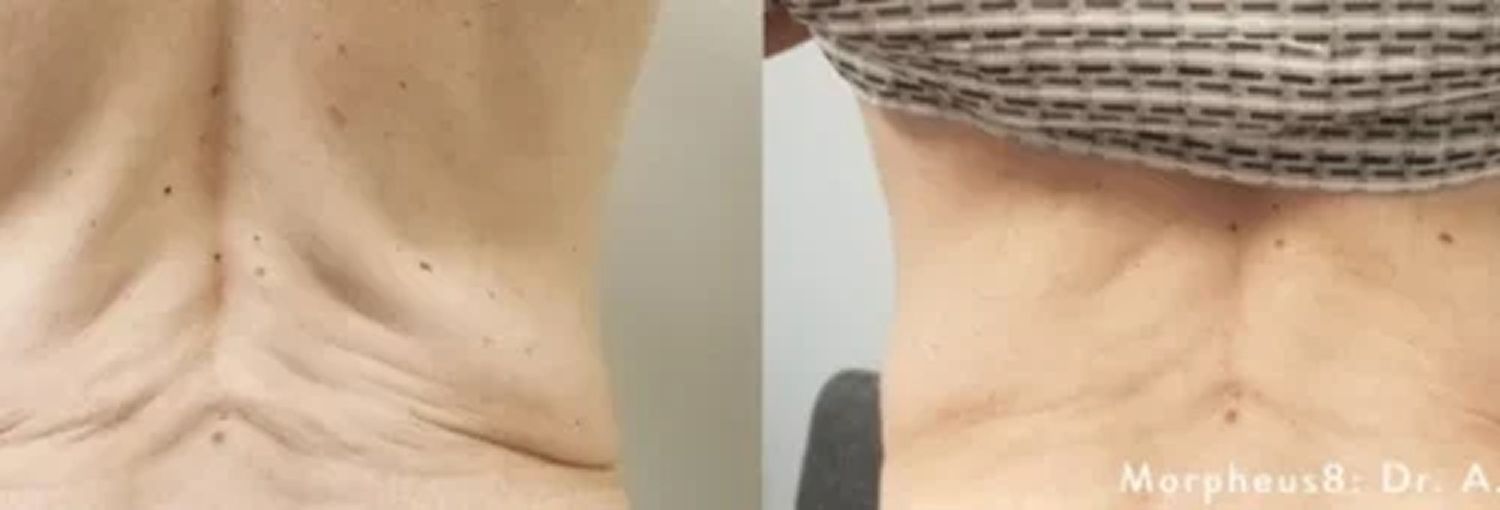 Morpheus8 Before & After