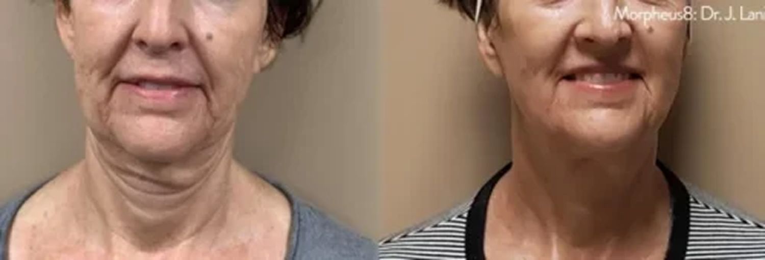 Morpheus8 Before & After