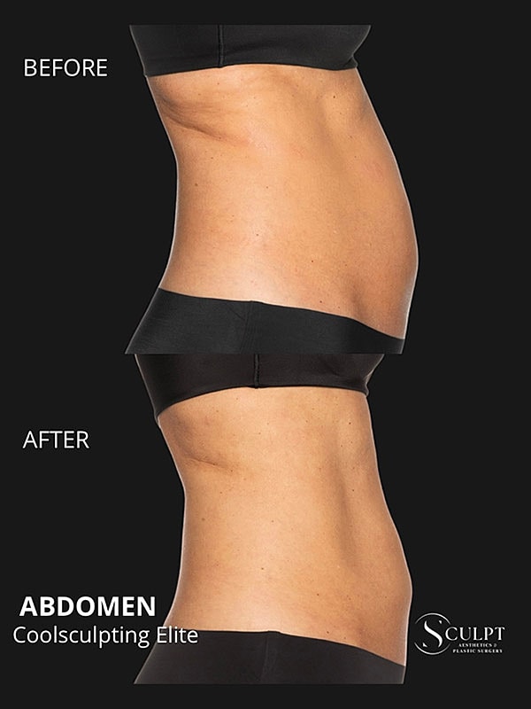 Coolsculpting Elite Before & After