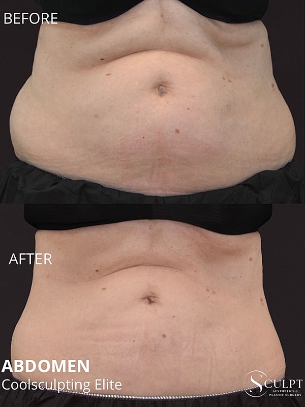 Coolsculpting Elite Before & After 
