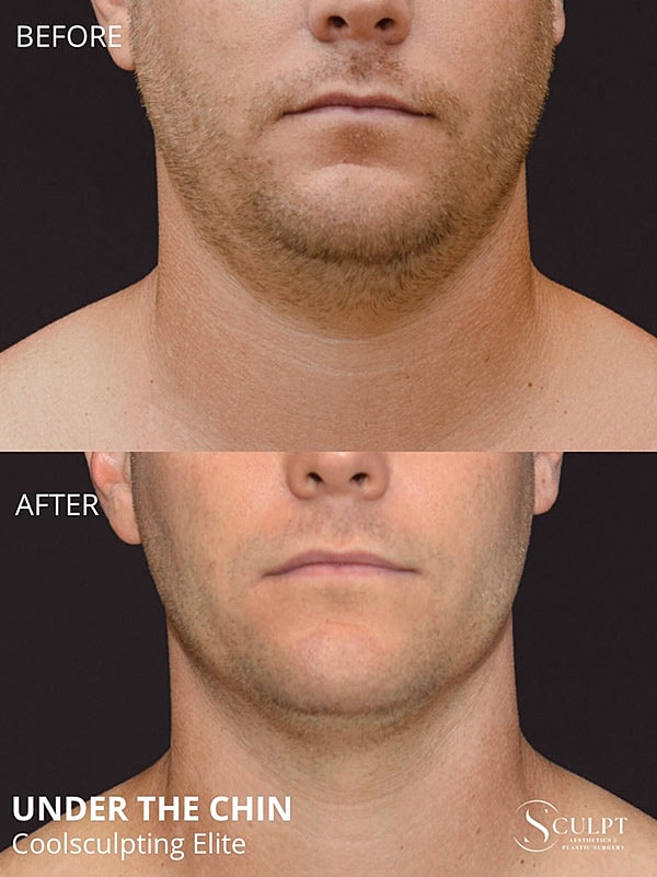 Coolsculpting Elite Before & After