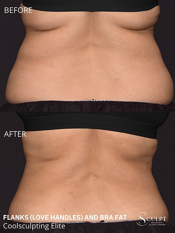 Coolsculpting Elite Before & After