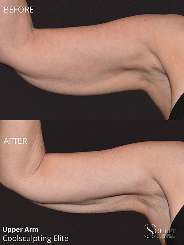 Coolsculpting Elite Before & After