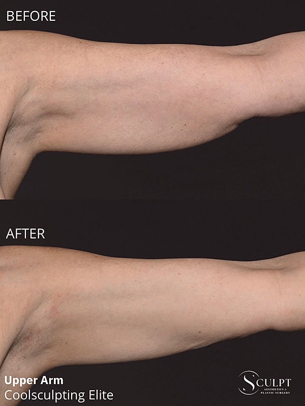 Coolsculpting Elite Before & After