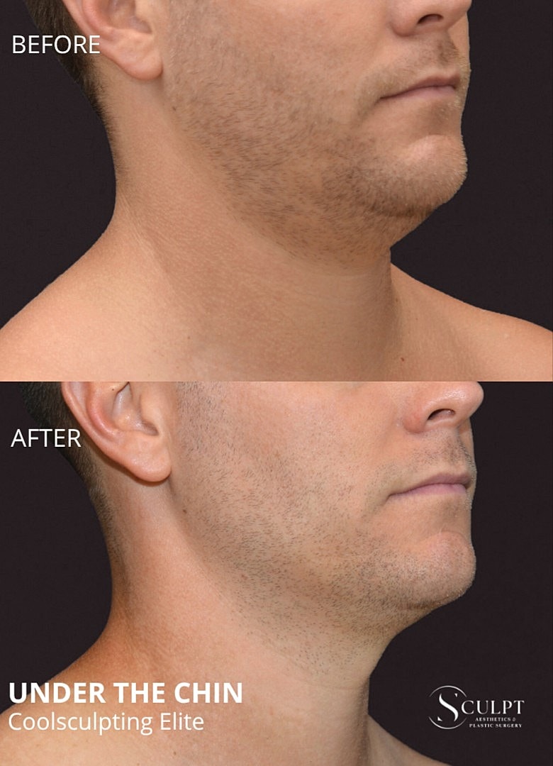 Coolsculpting Elite Before & After