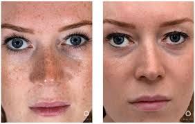 Perfect Derma Peel Before & After