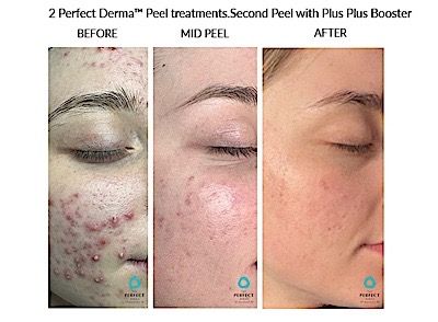 Perfect Derma Peel Before & After