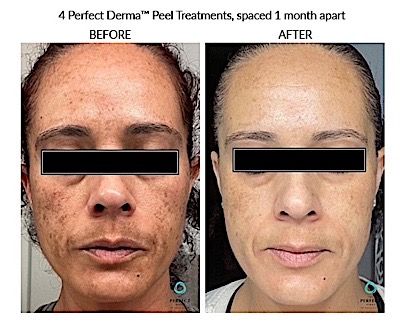 Perfect Derma Peel Before & After