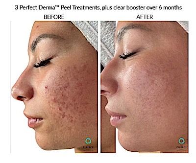 Perfect Derma Peel Before & After