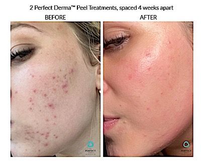 Perfect Derma Peel Before & After