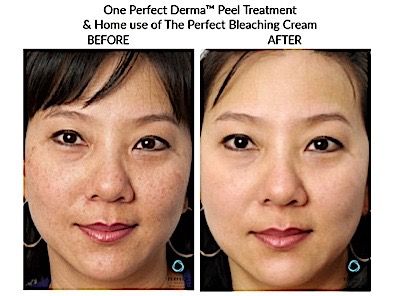 Perfect Derma Peel Before & After