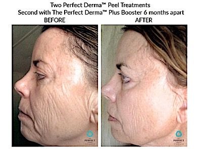 Perfect Derma Peel Before & After