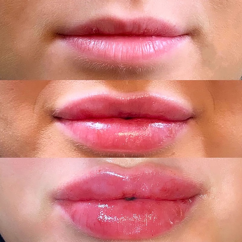 Lip Filler Before & After