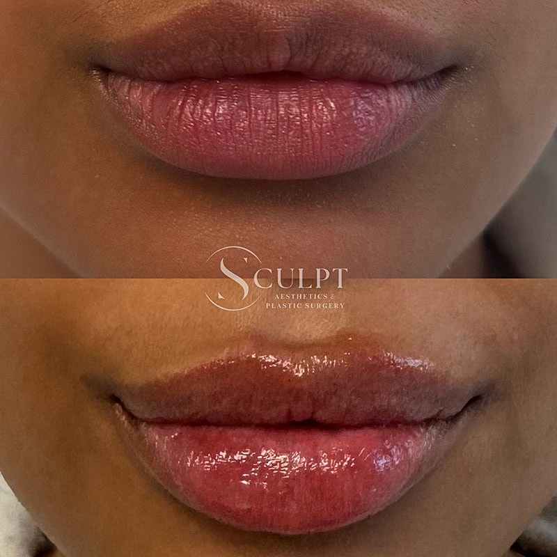 Lip Filler Before & After