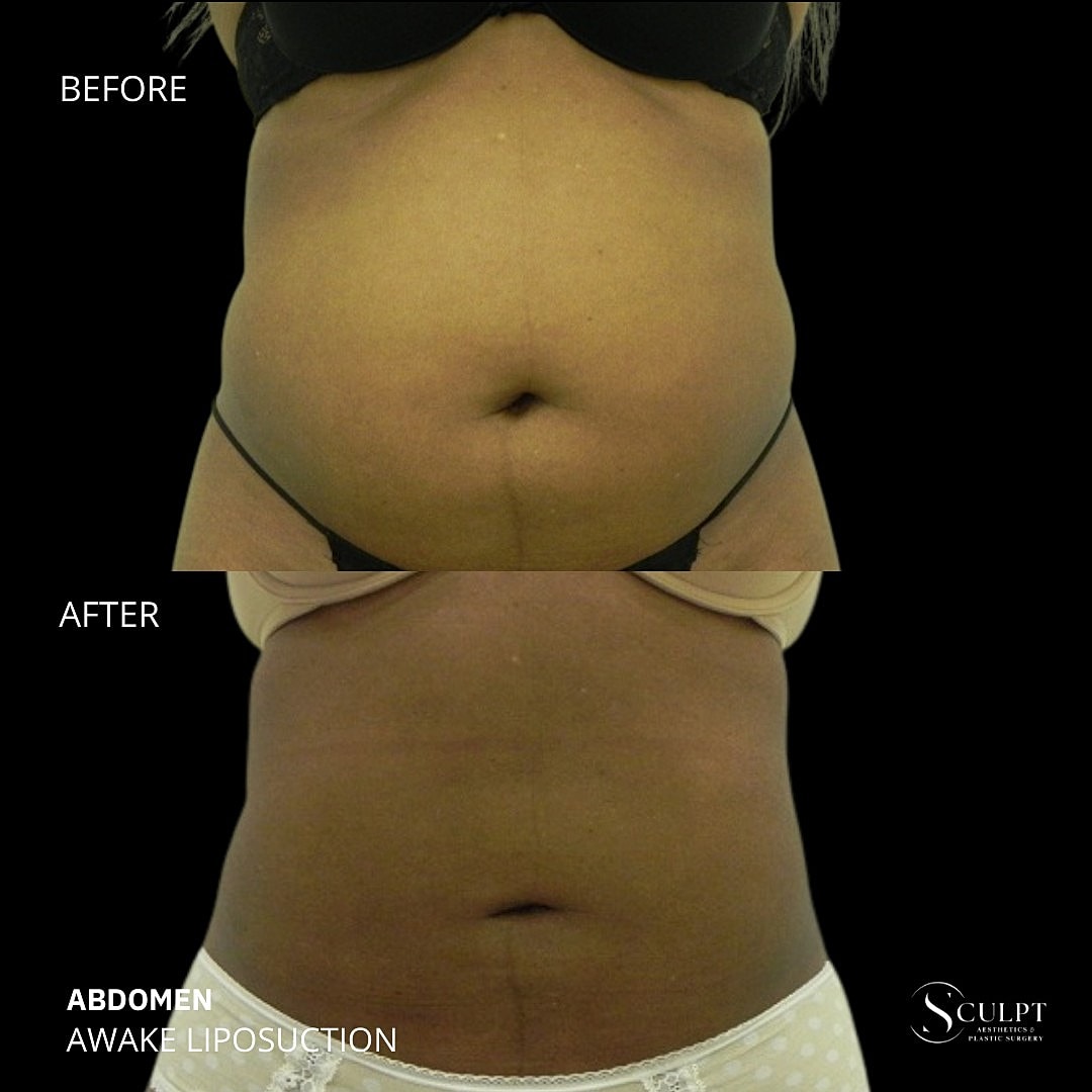 Liposuction Before & After