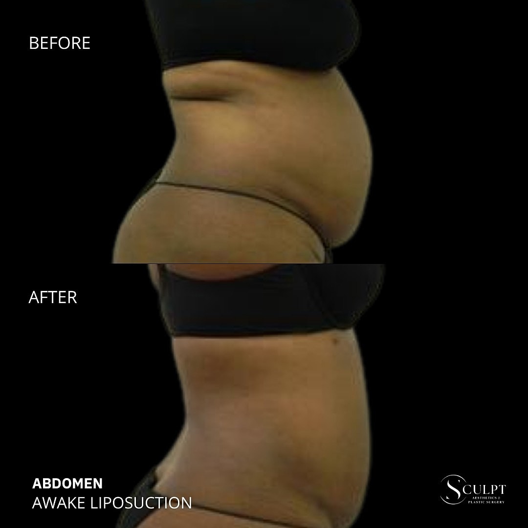 Liposuction Before & After