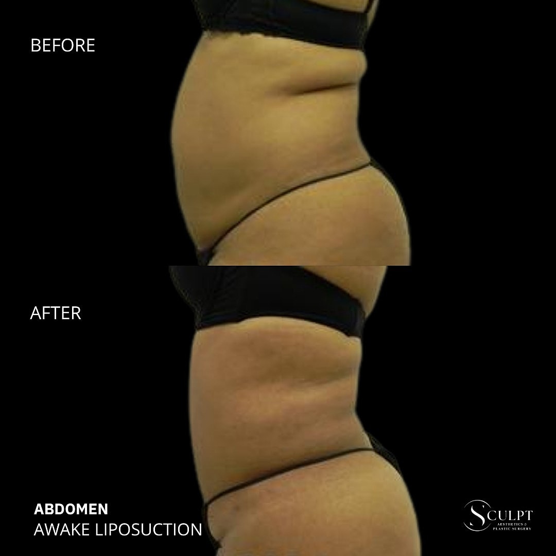 Liposuction Before & After